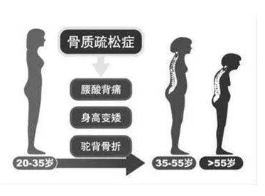 老年人骨密度测试仪器提醒女性50岁后该如何保养骨骼?